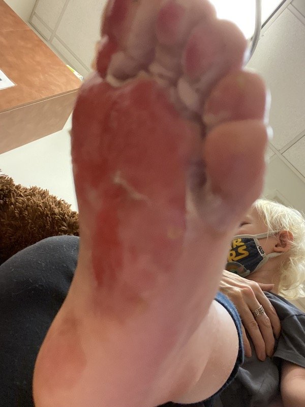 Luke's burned foot